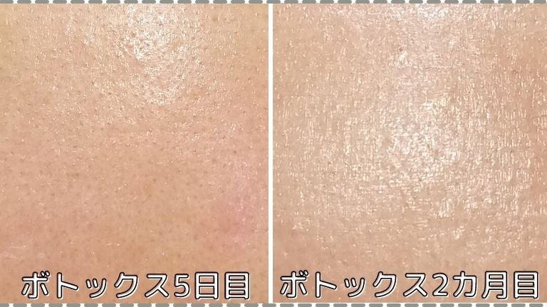 おでこ 眉間 アゴのボトックス2カ月目の経過を口コミレポ 湘南美容外科ボトックスの効果はどれくらい