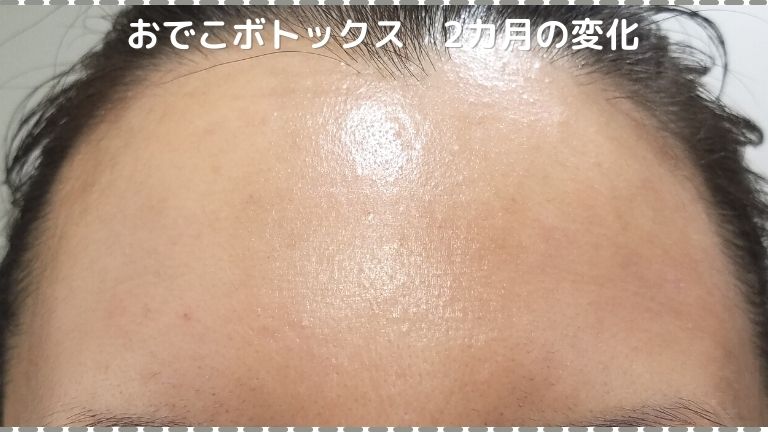 おでこ 眉間 アゴのボトックス2カ月目の経過を口コミレポ 湘南美容外科ボトックスの効果はどれくらい