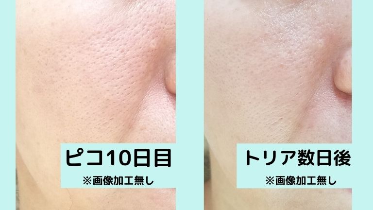 【美品✨】トリア・スキンエイジングケアレーザー トリア スキンエイジング アイケア レーザー TRIAスキンエイジングケア