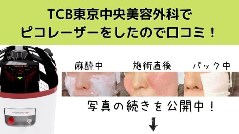 TCBでピコレーザーをしたので口コミします！トーニングと 