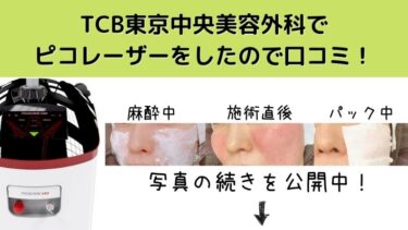 TCB東京中央美容外科でピコレーザーをしたので口コミします！トーニングとフラクショナルの毛穴の経過を写真でお伝えします！