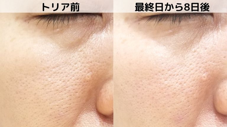 新品同様トリアレーザー まわそ