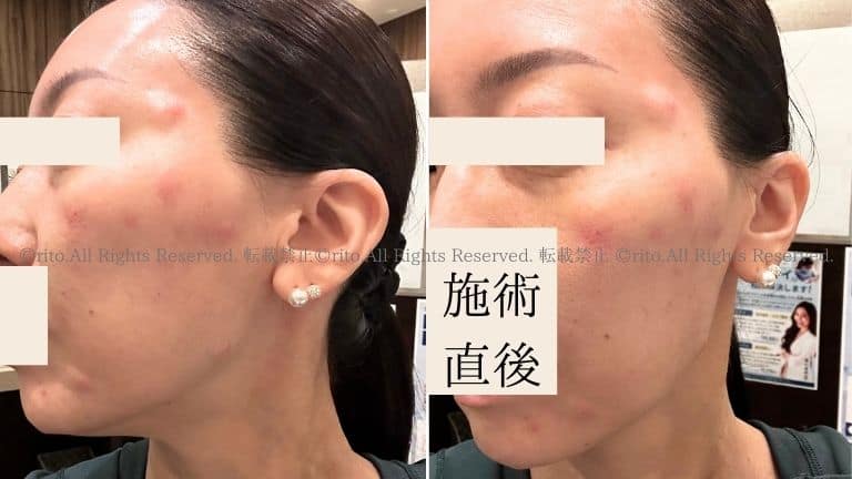湘南美容外科ジャルプロスーパーハイドロ初日施術直後口コミ (2)