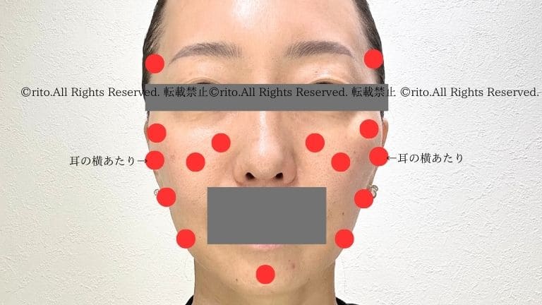 湘南美容外科ジャルプロスーパーハイドロ打った場所口コミ