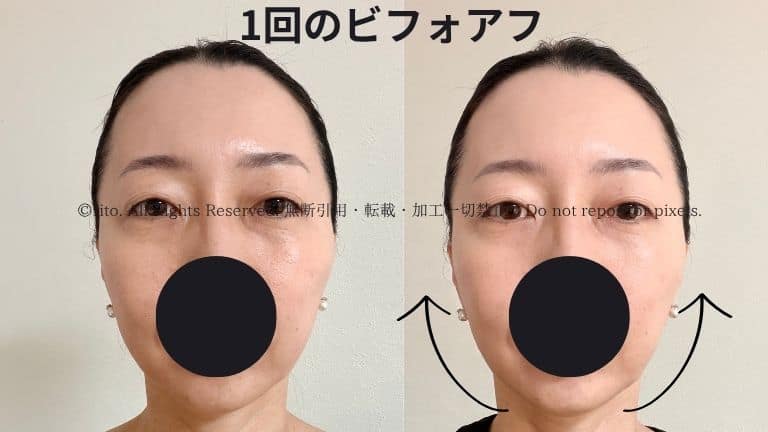 コアフィットフェイスポインタービフォアフ